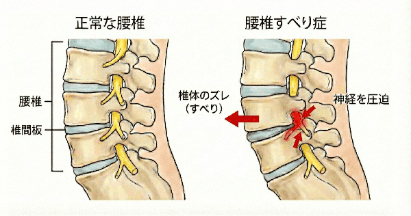 腰椎すべり症の症状についての説明画像