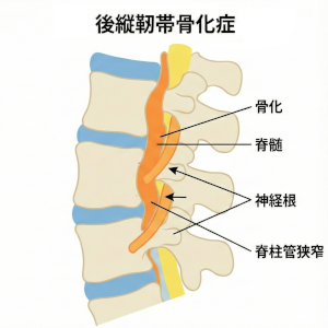 後縦靭帯骨化症の症状についての説明画像